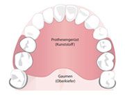 Drahtklammerprothesen