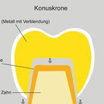 Teleskop- und Konuskronenprothesen