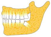 Weisheitszahn